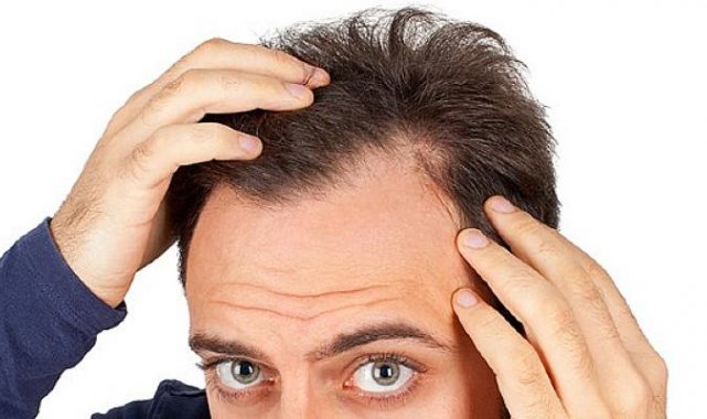 Erkeklerde Genetik Saç Dökülmesi Nasıl Önlenir? - Sağlık - Afyon Haber