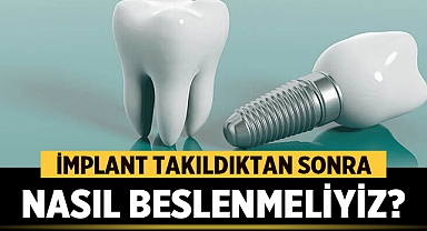 İmplant Takıldıktan Sonra Nasıl Beslenmeliyiz?